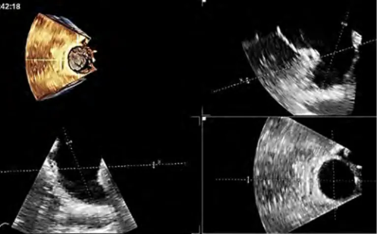 Figure 12. LV function by longitudinal strain before and after percutaneous balloon mitral commissurotomy