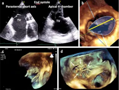 Figure 13. Functional TR. (a) Tenting of the leaflets and dilatation of  the tricuspid annulus by 2D and (b) annular dilatation from surgical  perspective by 3DE with correct measurement of annular dilatation in  surgical view (yellow arrow)