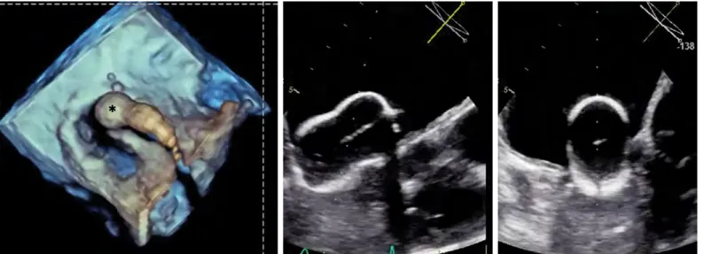 Figure 15. Percutaneous balloon mitral commissurotomy in a pregnant woman with minimal fluoroscopy, thanks to 3D TOE guidance (Asterix:  Innoue Balloon from the atrial perspective oriented to the stenotic mitral orifice)