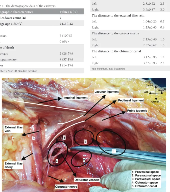 Figure 2. Pelvic anatomy and anatomic landmarks in a cadaver, left pelvic side wallTable 1