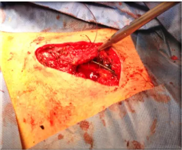 Figure 1. Muscular flap.