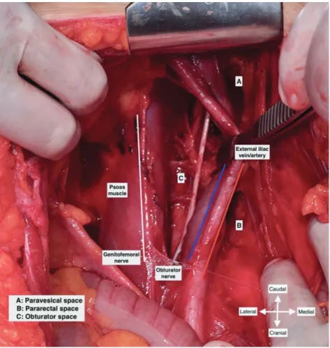 Figure 3. Exposure of obturator space after medial retraction of external iliac vessels (left pelvic side wall/live surgery- surgery-pelvic lymphadenectomy)