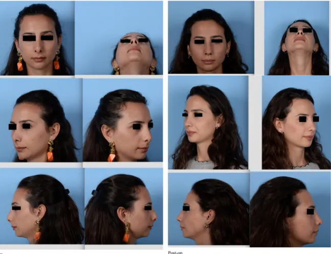 Figure 3 Patient 3. Pre and post-op photos.