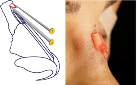 Figure 6 (1) Radix saw; (2) straight osteotome.