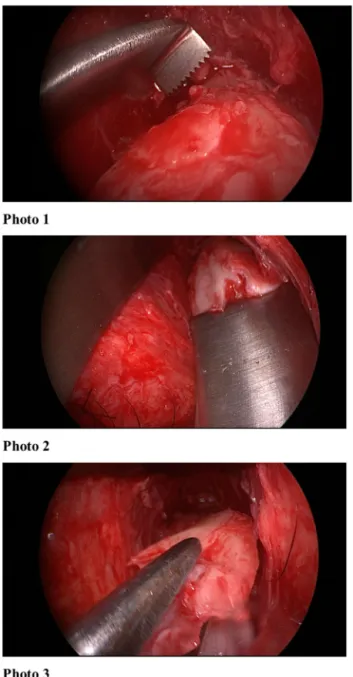 Figure 7 Per-op endoscopic view.