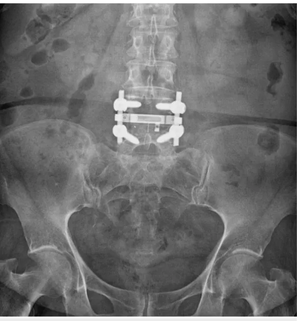 FIGURE 1: Postoperative radiograph of a patient with bilateral radiculopathy after a transforaminal interbody fusion