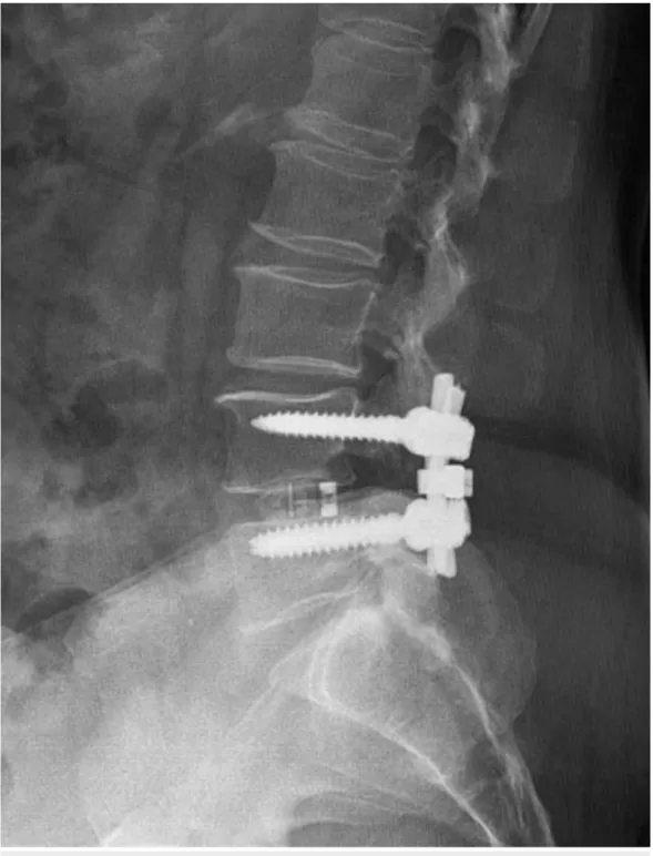 FIGURE 2: Postoperative radiograph of a patient with bilateral radiculopathy after a transforaminal interbody fusion