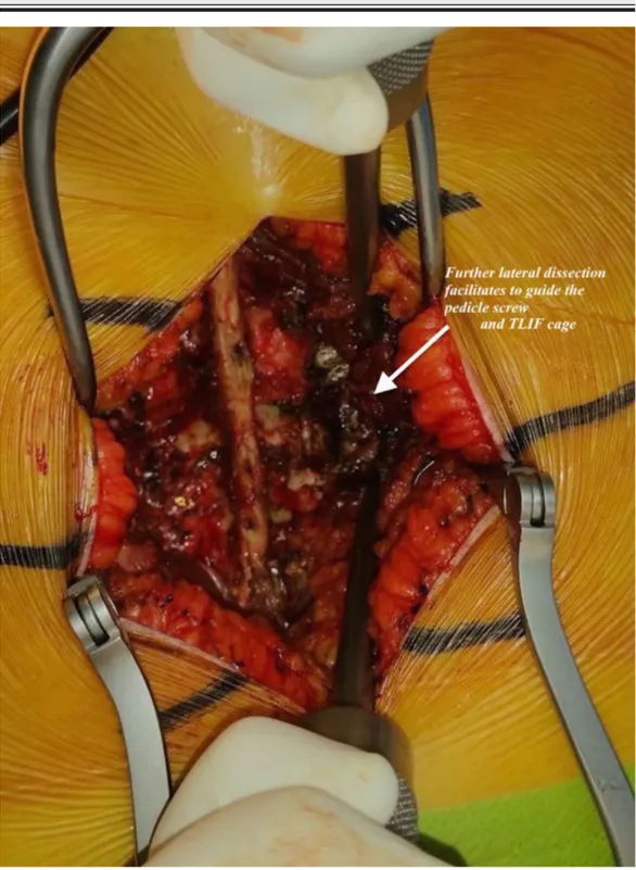 FIGURE 3: Lateral dissection in a patient in the body mass index 30-39.9 kg/m2 group.