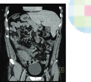 Figure 2: Laparoscopic view of the abdomen showing the liver at the  left and the spleen at the right side