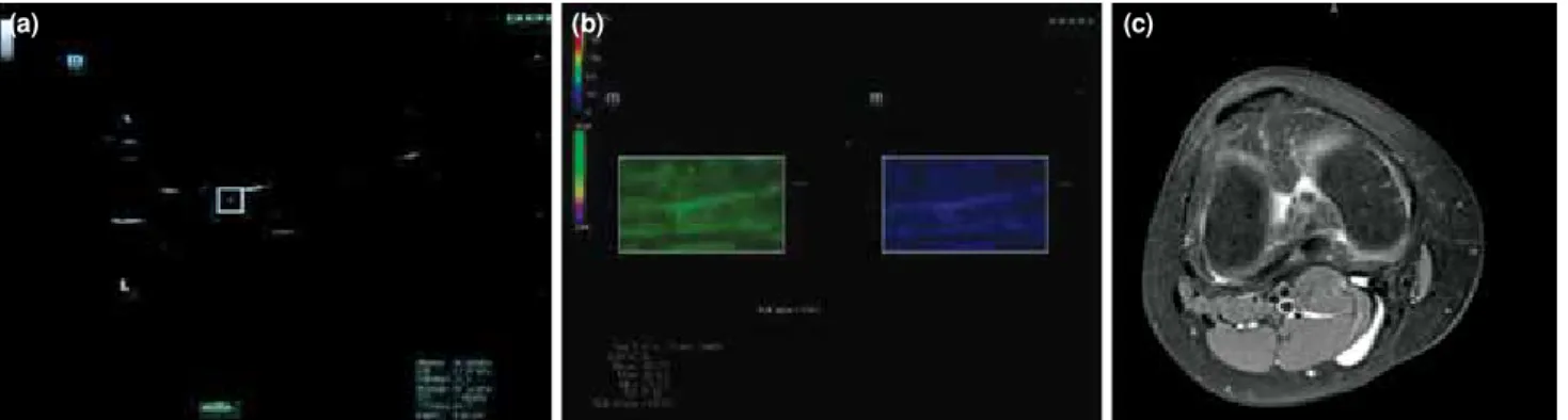 Figure 2. Point shear wave elastography (a), shear wave elastography (b) and magnetic resonance imaging (c) images of a patient  with grade I patellar tendinopathy
