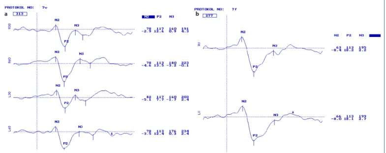 Figure 1. Pattern (a) and Flash (b) VEP of a healthy child of seven years old. Latency and amplitudes are seen in the first and second lines con- con-secutively at the right side of the curves