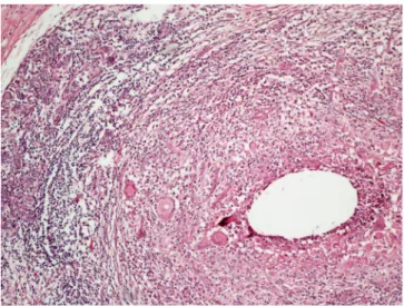 Figure  1 Histopathological examination showed replacement of  breast tissue by granulomatous type inflammation that composed  of histiocytes and lymphocytes
