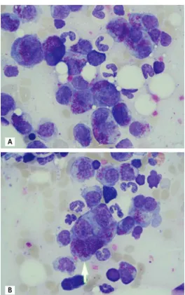 Figure 1. Bone marrow aspirate smear of a 73-year-old patient  with κ-type light chain myeloma (A and B)