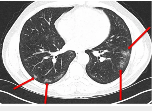 FIGURE 3: A 62-year-old female patient. Peripheral localized bilateral ground-glass opacities are more commonly observed on the left side.