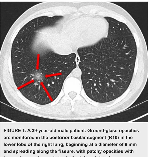 FIGURE 1: A 39-year-old male patient. Ground-glass opacities are monitored in the posterior basilar segment (R10) in the lower lobe of the right lung, beginning at a diameter of 8 mm and spreading along the fissure, with patchy opacities with increasing nu