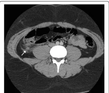 Fig. 1 Abdominal CT scan. In the right lower quadrant, inflammation in the pericecal region and tip of the remnant appendix tissue (arrow) is observed