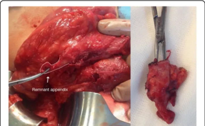 Fig. 3 Intraoperative view of stump appendicitis due to remnant appendix tissue