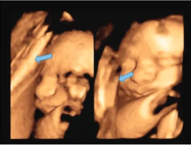 Figure 2. Intrauterine extra-amniotic adhesion demonstrated using  4D ultrasonography; “sheet on a string” appearance