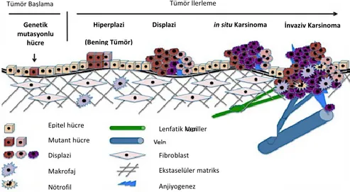Şekil 1. Tümör gelişimi basamakları: Normal hücrelerden metastaza kadar  2.2.   KANSER HÜCRELERİNİN ÖZELLİKLERİ 
