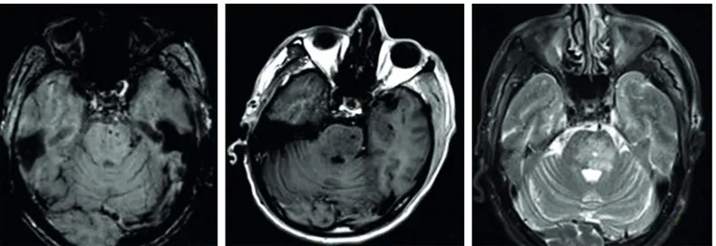 Figure 1. Axial T1 (A), T2-weighted images (B) and susceptibility weighted images (C) MR scan showed heterogenous hyperintense lesion with  hemorrhage at the left site of the pons.