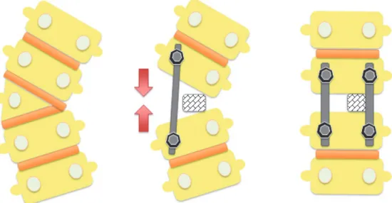 Figure 2: Correction of the coronal plan deformities using mesh cage after hemivertebra resection.