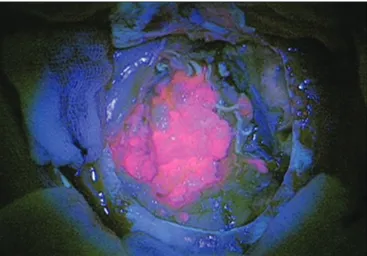 Şekil 2: Sağ  temporal yerleşimli  metastatik tümörün  dura açıldıktan sonra  mikroskop altında         Na-Fl görünümü.