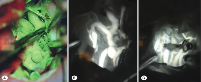 Şekil  3:  Kanamamış  MCA  anevrizmasının  Na-Fl  ve  ICG  videoanjiografi  görünümü  (A,  B)  ile  kliplenme  sonrası  ICG  videoanjiyografi  görünümü (C).