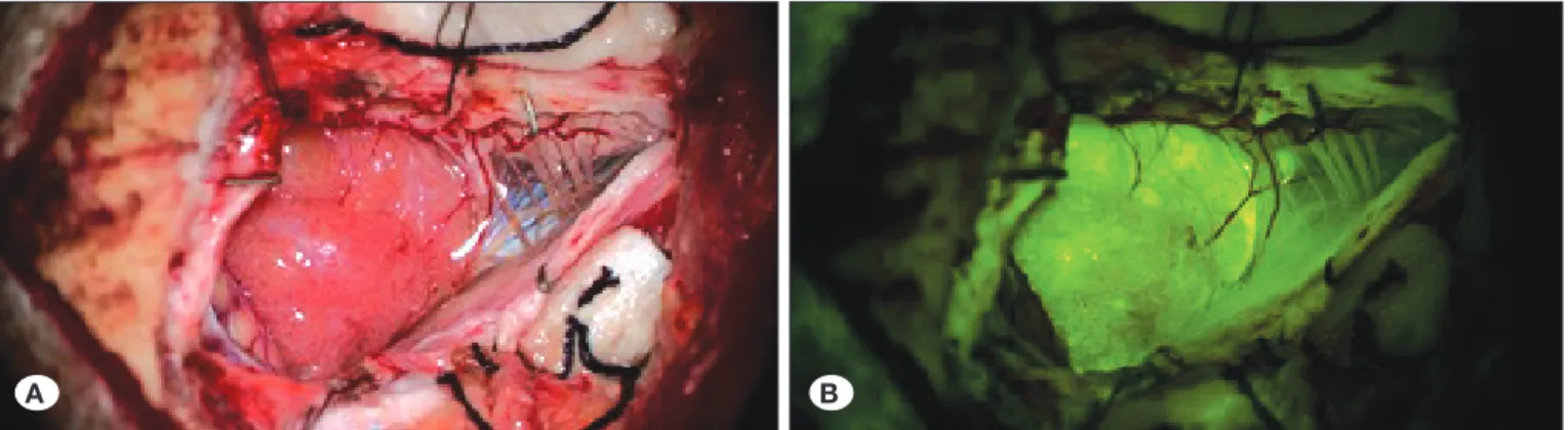 Şekil 5: Foramen magnum yerleşimli meningiom (A) ve Na-Fl görüntüsü (B).