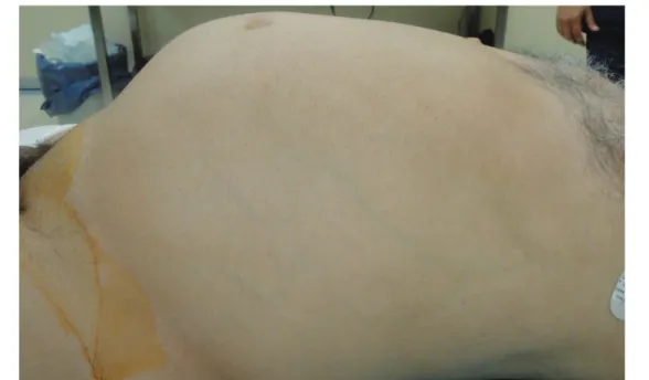 Figure 1. Preoperative patient’s view; apparent palpable intraabdominal mass
