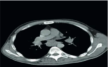 Figure 2 - Thorax CT showing bilateral hilar and mediastinal lymph- lymph-adenopaties.