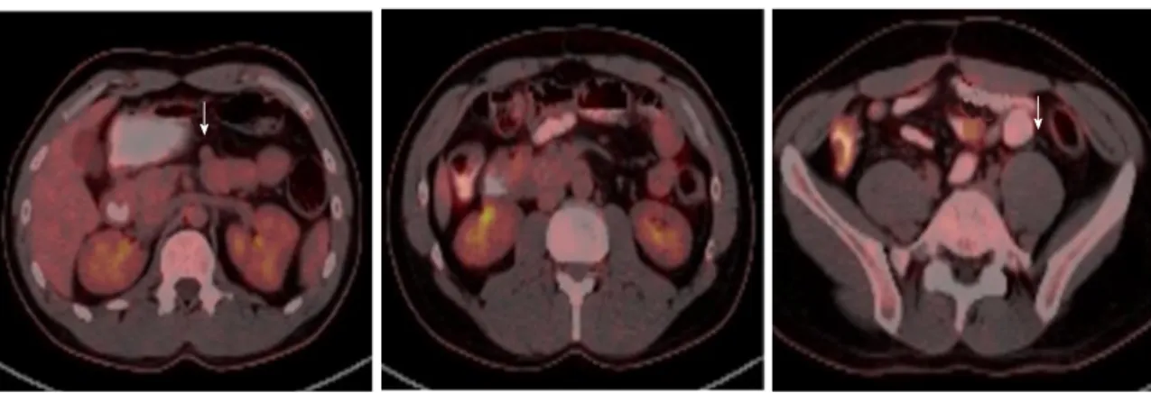 Figure 4   18 F-fluorodeoxyglucose positron emission tomography-computerized tomography scans of the gastrointestinal stromal tumors recurrence