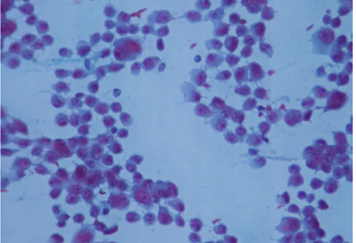 Fig. 1 : FNA: Malignant cells showing little cohesion, prominent  nucleoli, pleomorphism and multinucleation