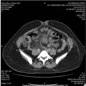 Figure 1. 8.1 millimeter enlarged appendix  