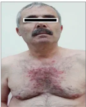 FIGURE 1: Widespread papulopustular lesions in the chin and chest region.