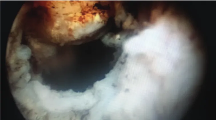 Figure 1. Perforation of the uterus during hysteroscopic  myomectomy