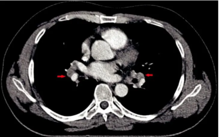 Figure  1:  Torax  computed  tomography  showed  bilateral  hilar  lymphadenopathy 