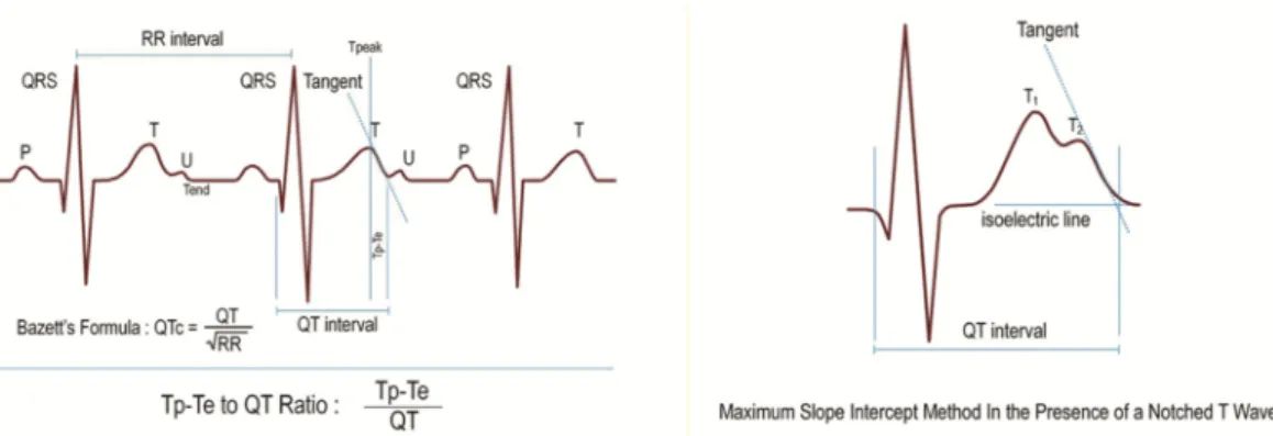 Figure 1. T wave peak-to-end interval (Tp-Te), QT interval, RR interval, Bazzett’s Formula, Tp-e/QT  Ratio, and maximum slope intercept method in the presence of a notched T wave