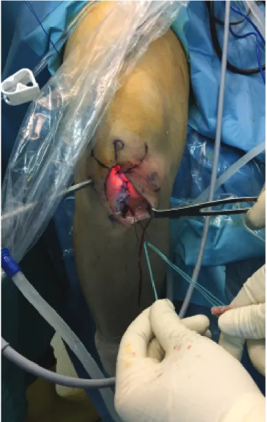 Figure 4. Loading graft to passing suture Rehabilitation