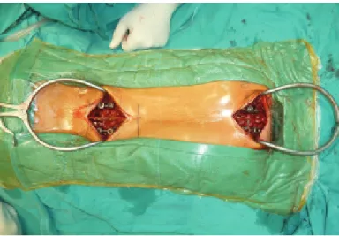 Figure 1. Intraoperative view of minimal invasive magnetically  controlled dual rod application.