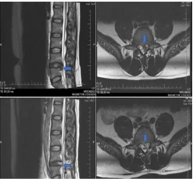 Figure 1. Preoperative sagittal and axial lumbar MRI images and  early postoperative sagittal and axial lumbar MRI images of a  37-year-old male patient