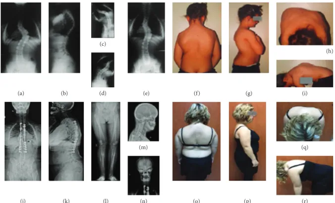 Figure 1: (a–i) CCD in an adolescent patient (B.Y.) accompanied by bilateral pseudoarthrosis of the clavicle, small face, protruding forehead, open anterior fontanelles, tooth eruption problems, short stature, and coxa vara