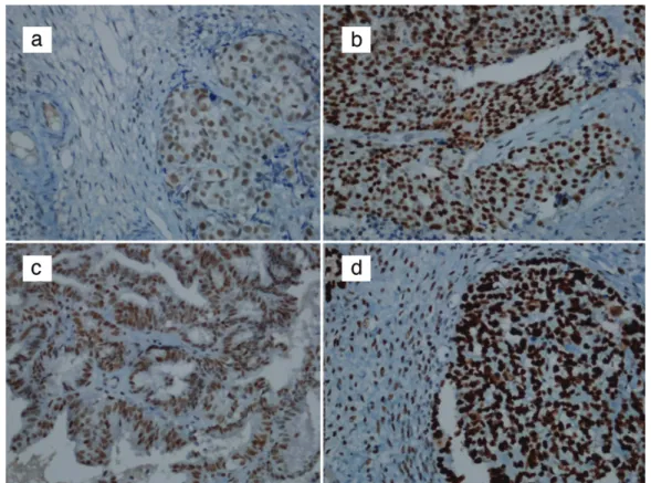 Table 2. Relation between age, tumor type, FIGO stage, histological grade and MMR protein expression loss MMR protein expression  pPresentAbsent n % n % Age (year) <60  104 (98.11) 2 (1.89) 1.000 ≥60  52 (98.11) 1 (1.89) Tumor­type Serous carcinoma 95 (