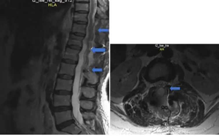 Figure 1. a) Preoperative T2 MRI sagittal section of the thoraco- thoraco-lumbar spine shows hyperintense T11-L1 SSEH and cord  compres-sion (blue arrows); b)  Axial view of SSEH in the thoracolumbar  spine in a preoperative T2 MRI section (blue arrow)