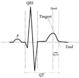 Figure 3. Schematic presentation of the measure- measure-ment of the Tp-Te and QT interval