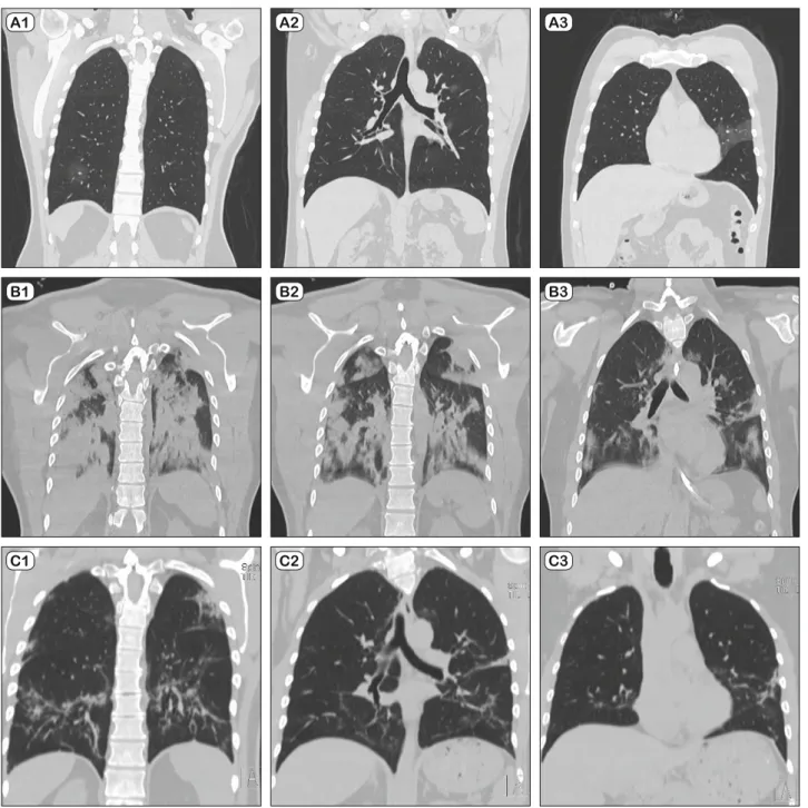 Fig. 1. Radiological evaluation of patient lungs. A1‒3: focal ground-glass opacity in the lower part of the lung observed on day 5 after fi rst  symptom onset