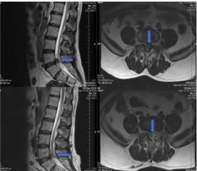 Figure 1. Preoperative sagittal and axial lumbar MRI images  (upper figures) and early postoperative sagittal and axial lumbar  MRI  images  (lower  figures)  of  a  65-year-old  male  patient