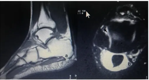 Tablo 3: MRG’da  impingement ve kontrol grubunda osteofit dağılımı ve sayısı (N*: Olgu sayısı)  İmpingement (N=30)  Kontrol grubu (N=20) 