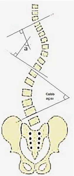 Şekil 1: Cobb açısı ölçüm yöntemi 