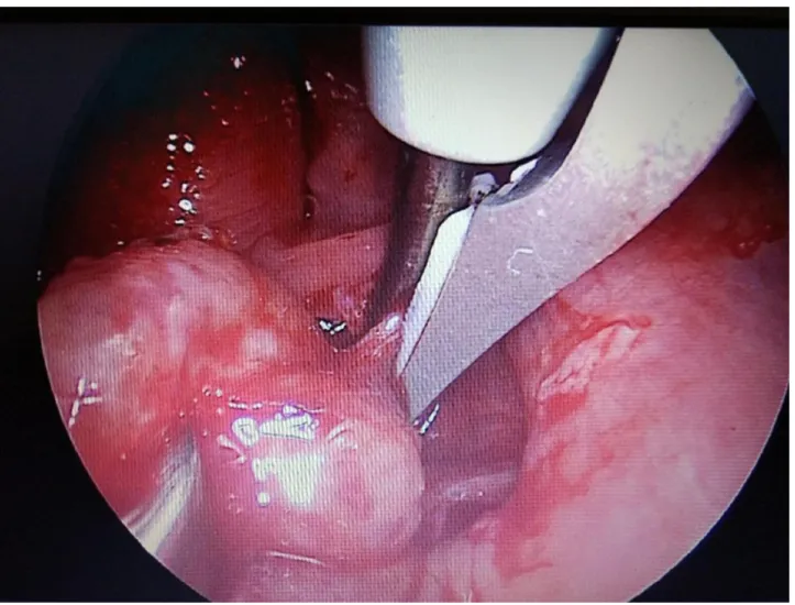 Figure 2. Harmonic scalpel tonsillectomy. 
