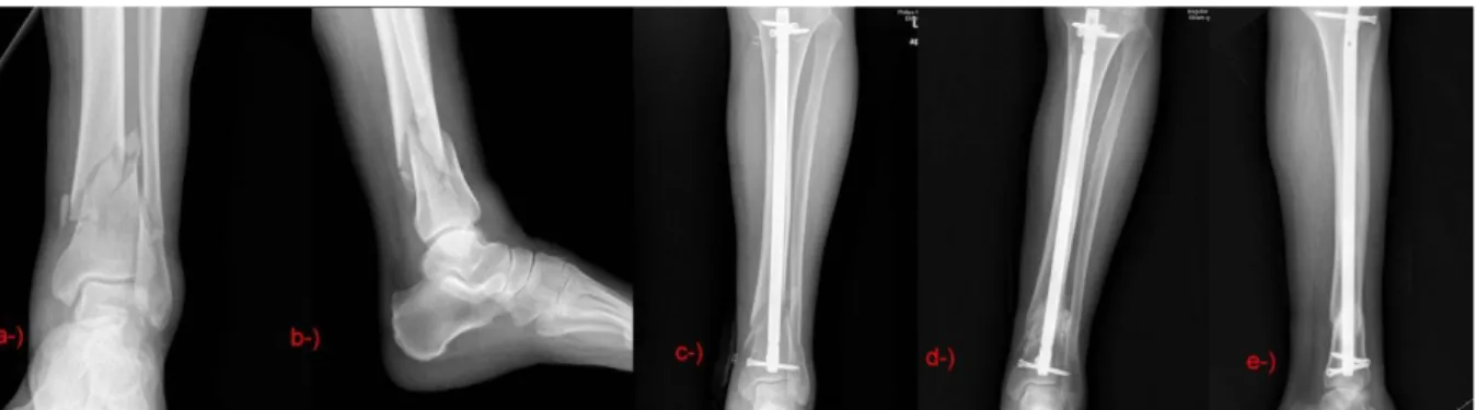 Figure 1: Seventy-year-old male AO/OTA type 43A3 a, b) Preoperative X-rays c) Early postoperative X-ray d,  e) Postoperative X-ray at 19 th month 